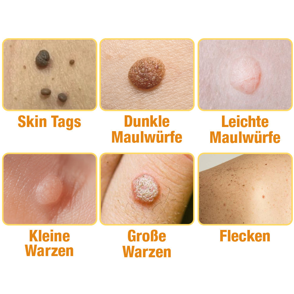 Bee Spray For Removing Warts And Moles 14981445255494-1