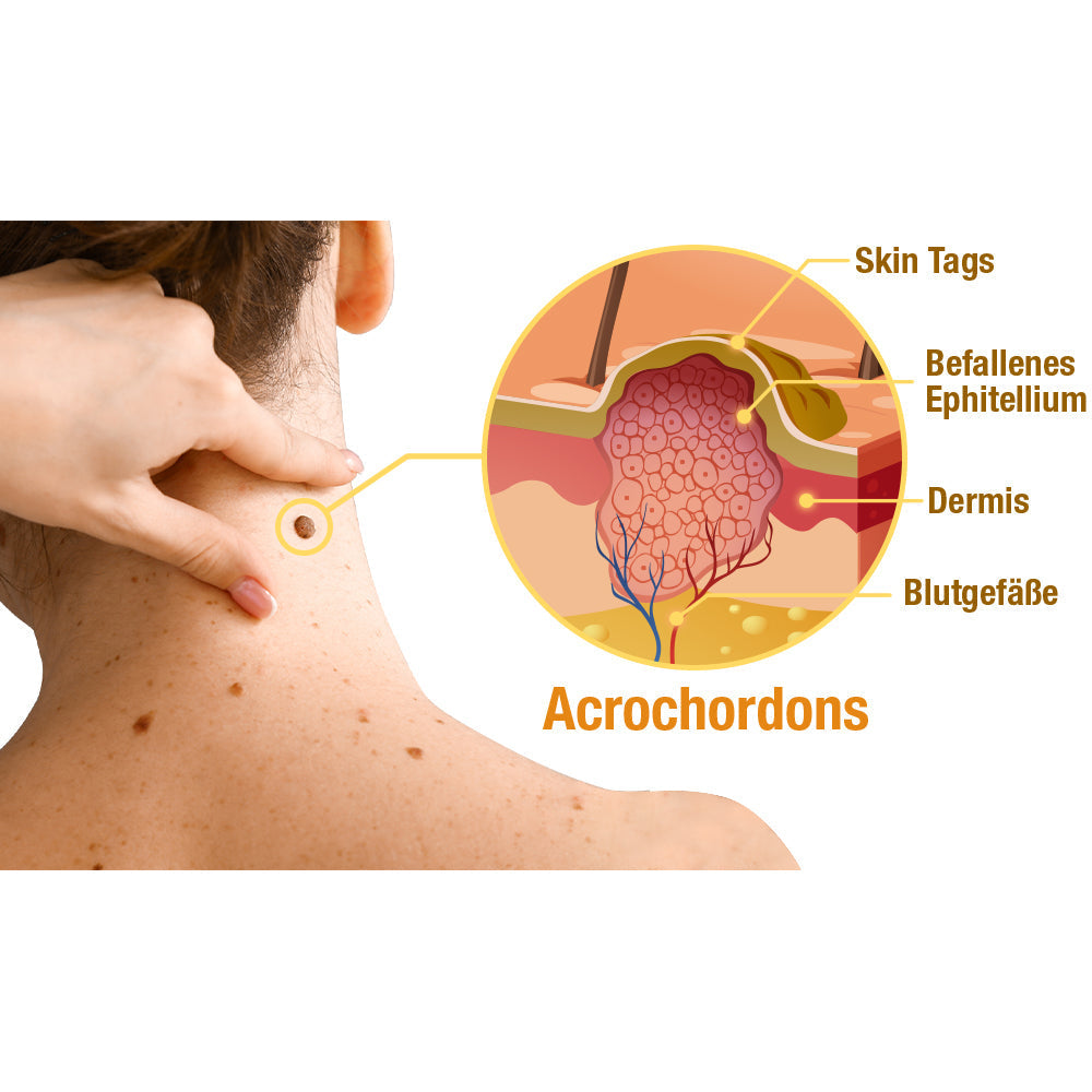 Bee Spray For Removing Warts And Moles 14981445255494-1