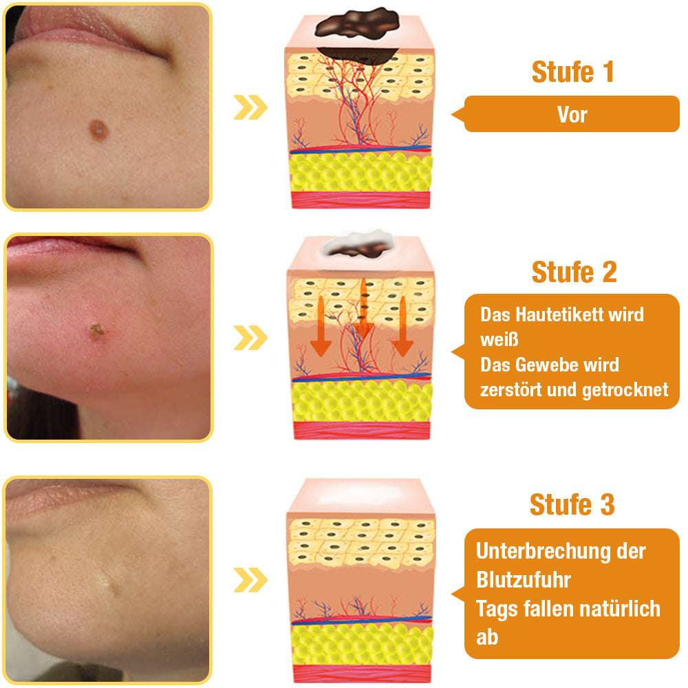 Bee Spray For Removing Warts And Moles 14981445255494-1