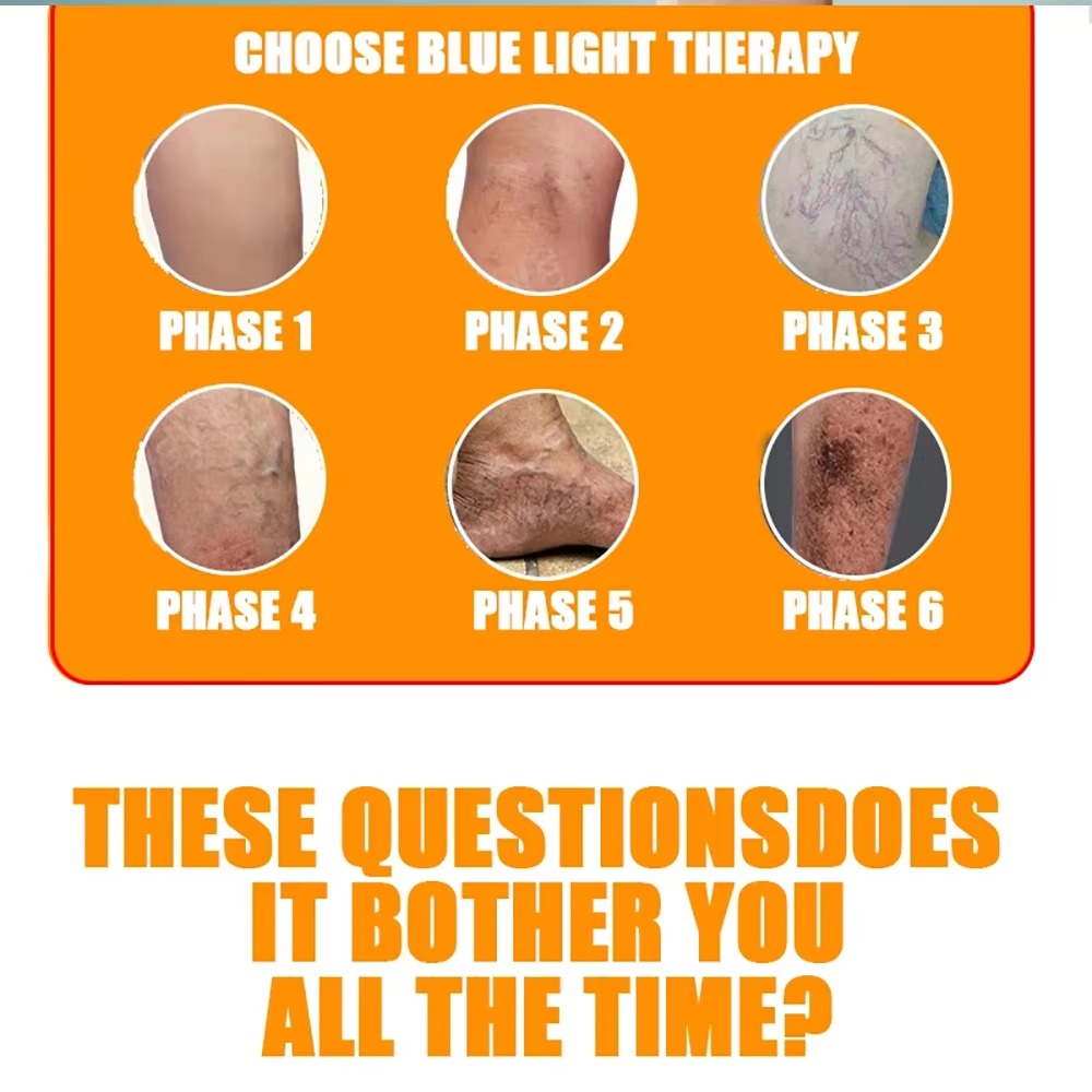 Spider Veins Removal Pen