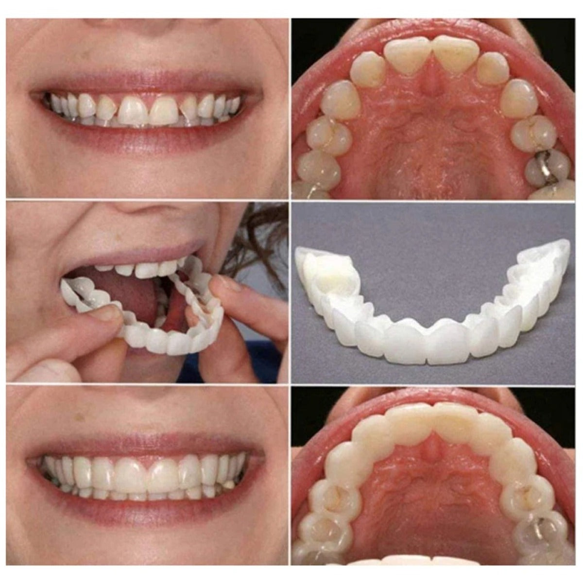 Dental Aligner For Whitening Teeth And Invisible Orthodontic Comfort
