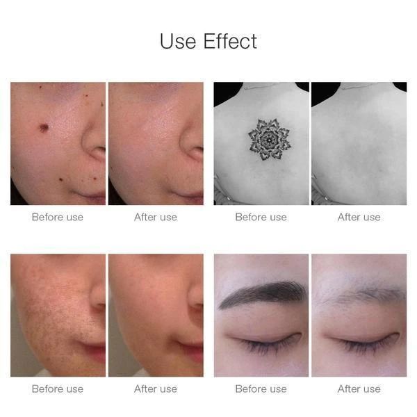 Laser Pen for Mole, Tattoo, Dark Spot, Acne Removal at Home