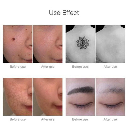 Laser Pen for Mole, Tattoo, Dark Spot, Acne Removal at Home