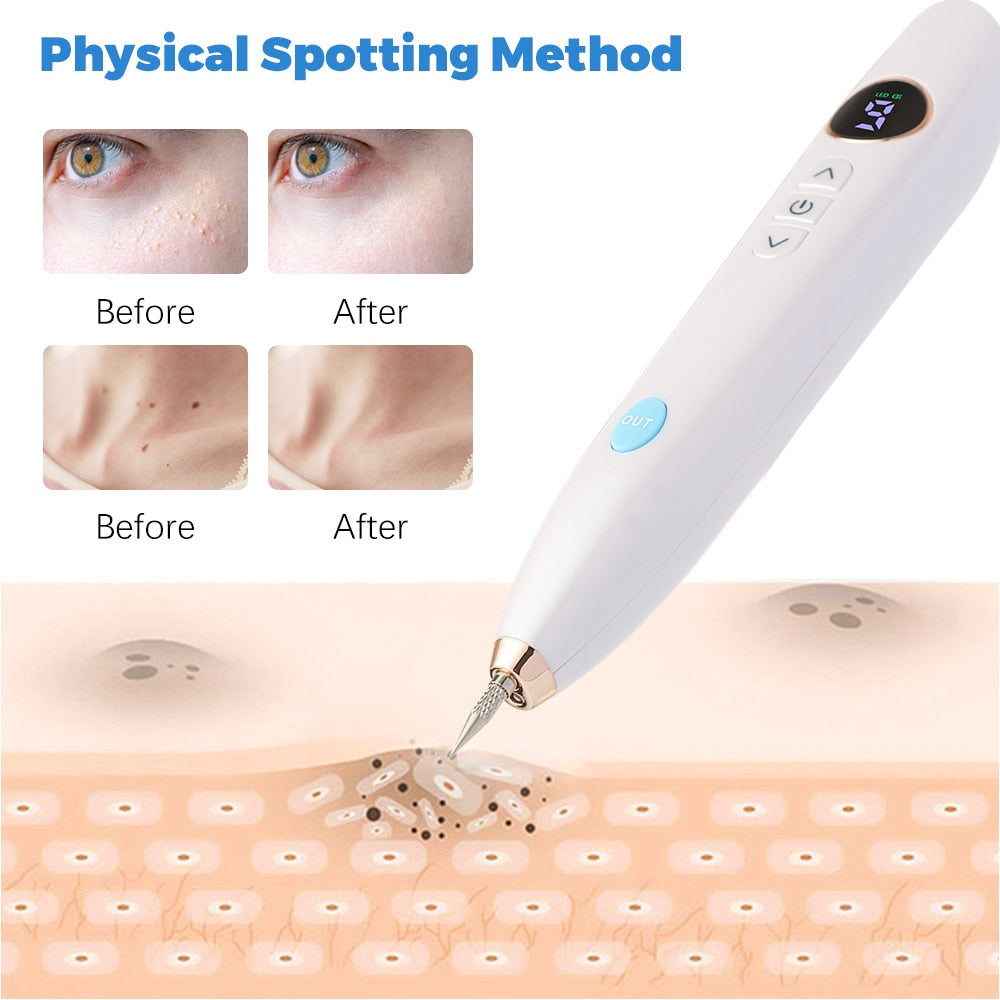 Plasma Mole &amp; Dark Spot Removal Pen