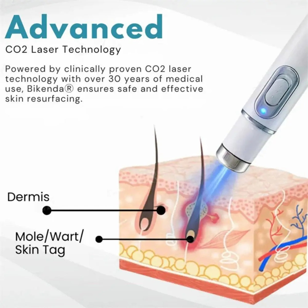 Non-Invasive Mole and Wart Removal Laser Pen