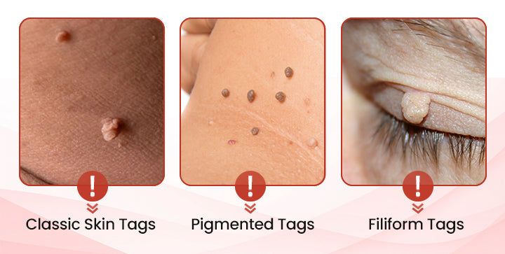 Painless Micro-Patch For Skin Tag, Mole & Wart Removal 12026003226942-1