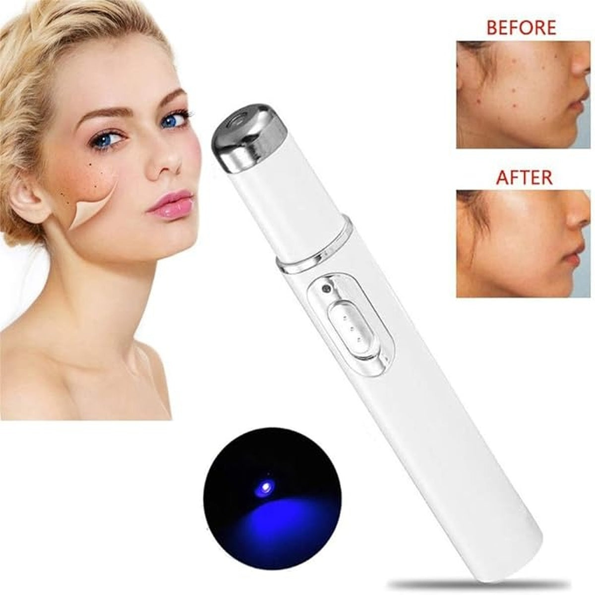 Non-Invasive Mole and Wart Removal Laser Pen