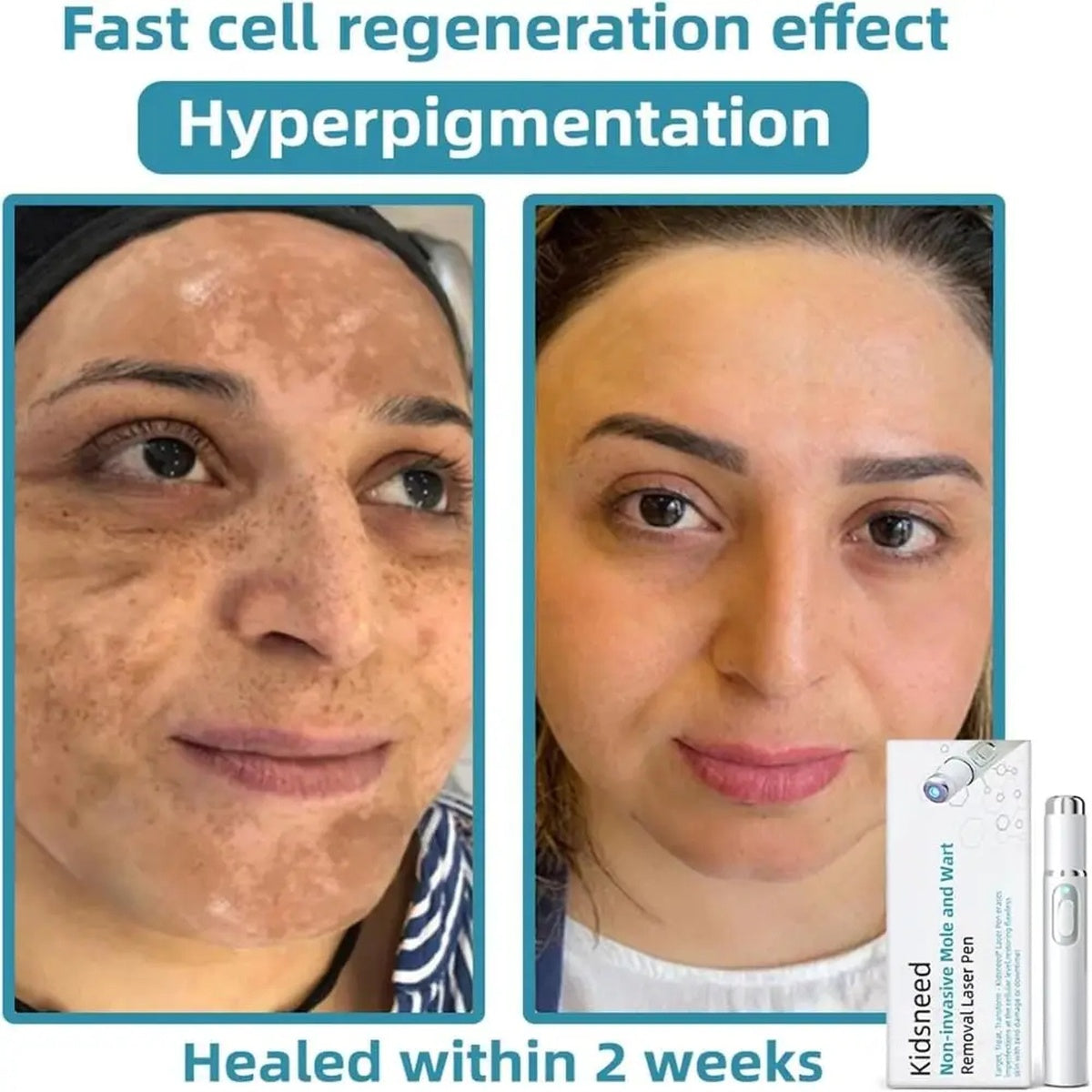 Non-Invasive Mole and Wart Removal Laser Pen