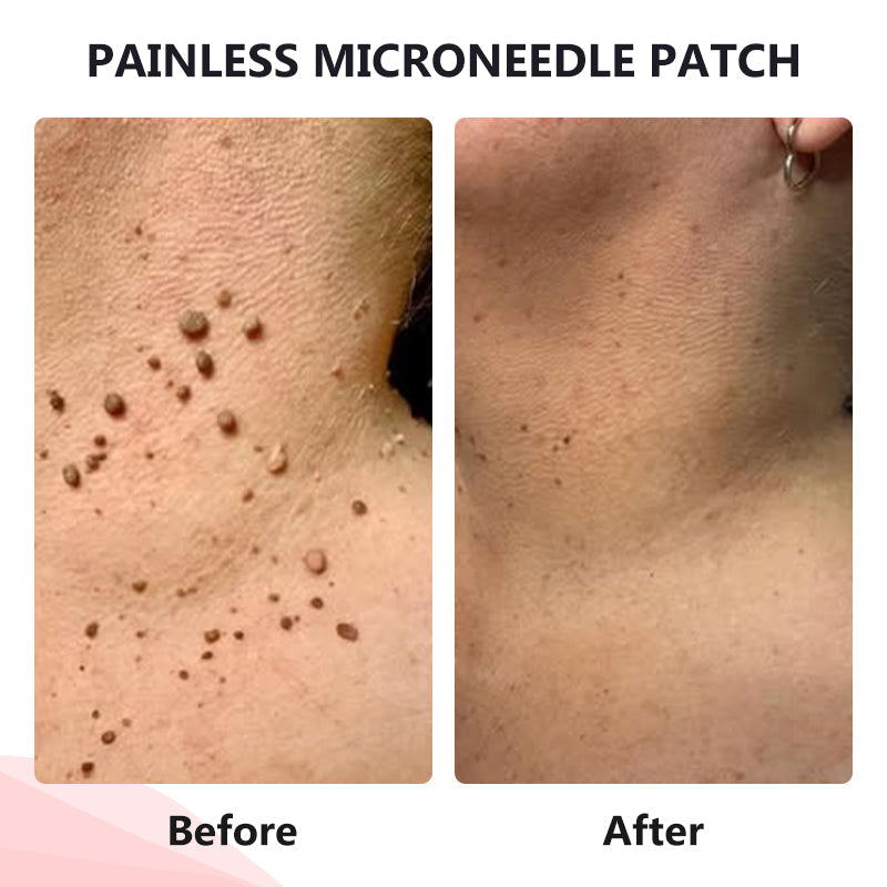 Painless Micro-Patch For Skin Tag, Mole & Wart Removal 12026003226942-1