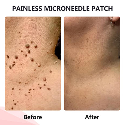 Painless Micro-Patch For Skin Tag, Mole & Wart Removal 12026003226942-1