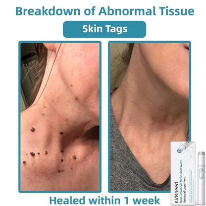 Non-Invasive Mole and Wart Removal Laser Pen