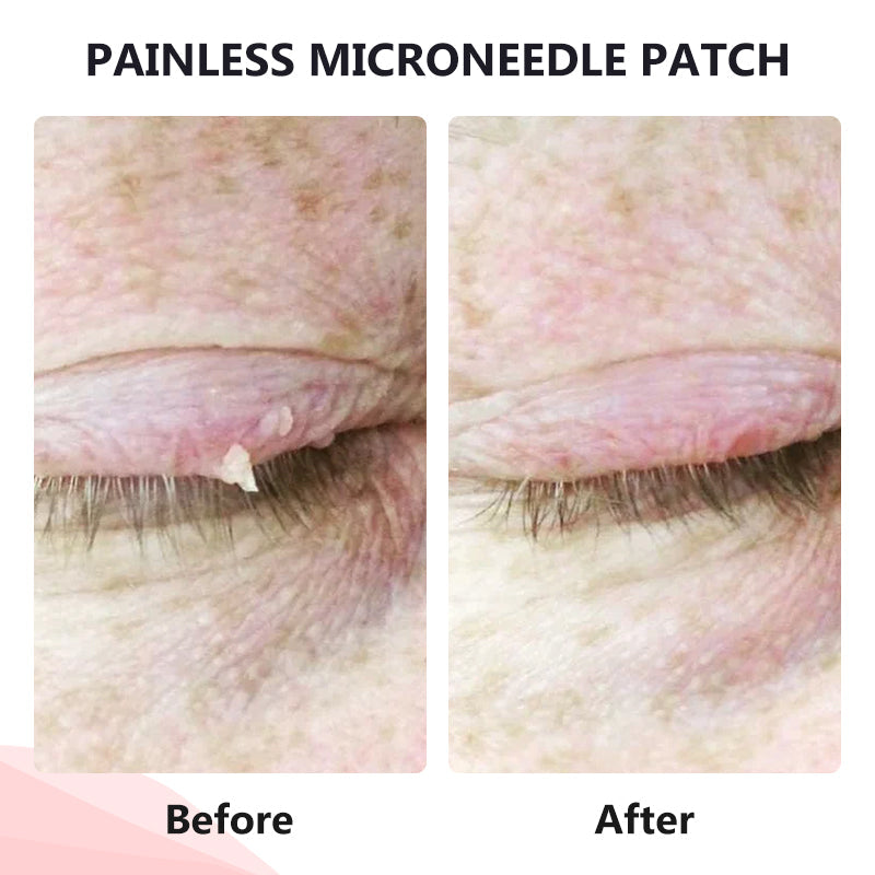 Painless Micro-Patch For Skin Tag, Mole & Wart Removal 12026003226942-1