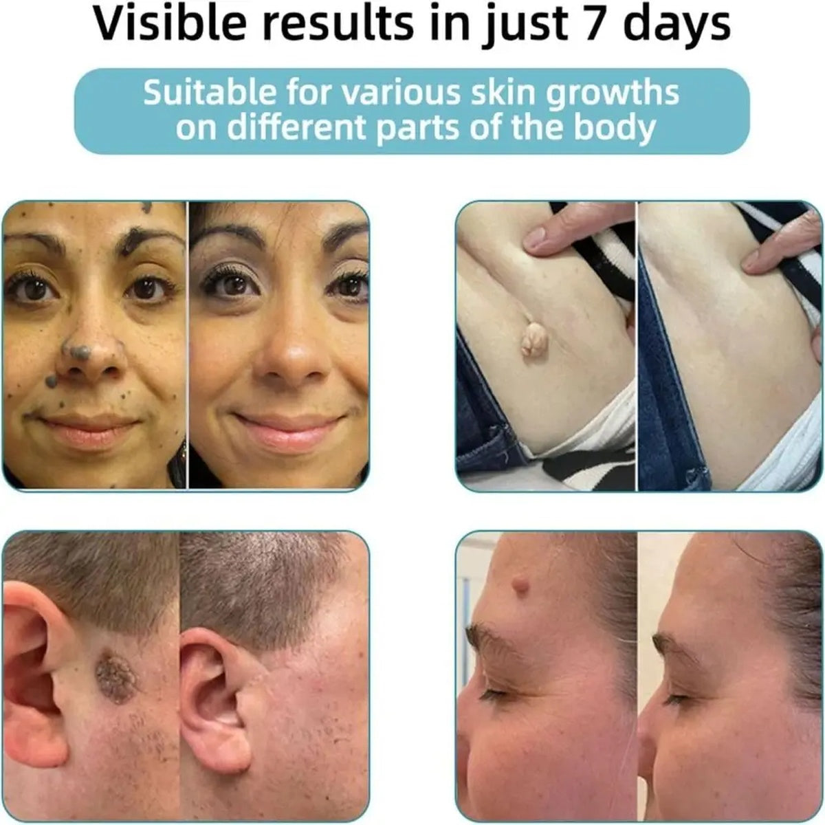 Non-Invasive Mole and Wart Removal Laser Pen