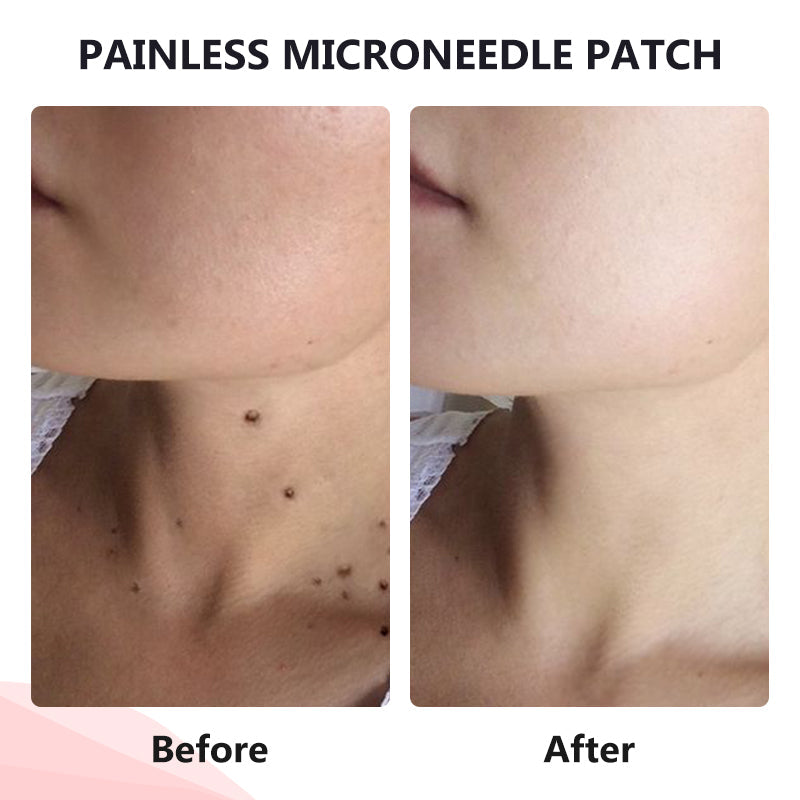 Painless Micro-Patch For Skin Tag, Mole & Wart Removal 12026003226942-1