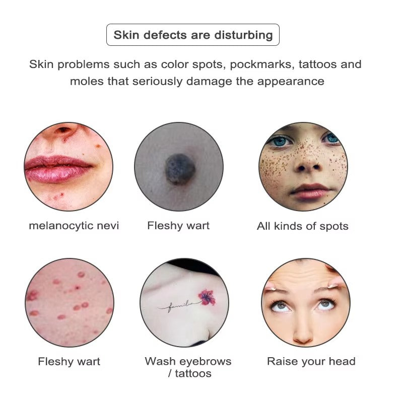 Laser Pen for Mole, Tattoo, Dark Spot, Acne Removal at Home