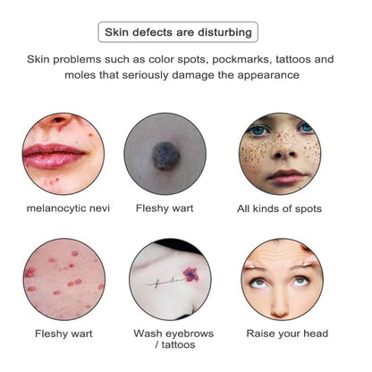 Laser Pen for Mole, Tattoo, Dark Spot, Acne Removal at Home