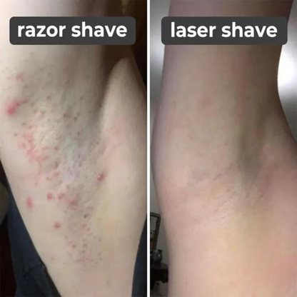 Laser Hair Remover Rechargeable Painless Device Smooth Skin Technology 14901560049990-1