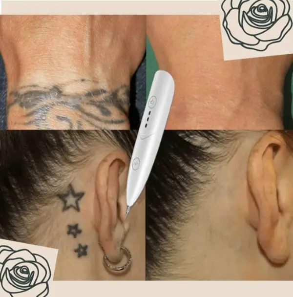 Instant Tattoo Removal Pen