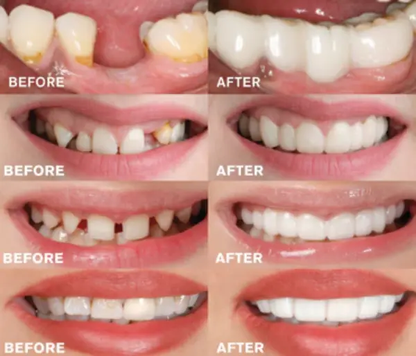 Magic Teeth Snap On Veneers3