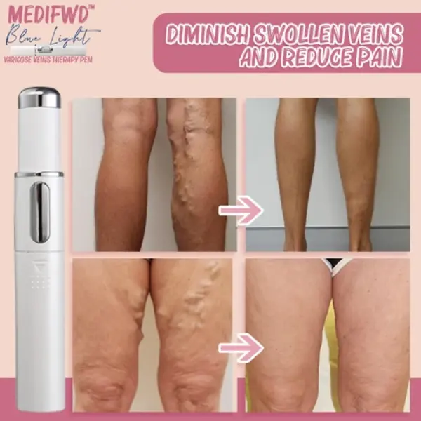 Medifwd Blue Light Therapy Varicose Veins Pen