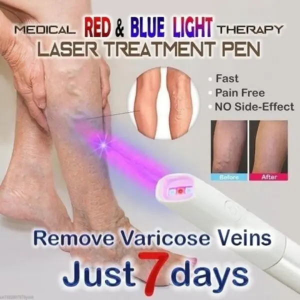 Medifwd Blue Light Therapy Varicose Veins Pen