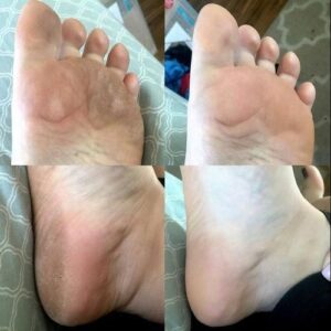 Callus Removal photo review