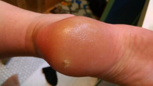 Callus Removal photo review