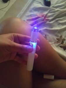 Medifwd Blue Light Therapy Varicose Veins Pen photo review