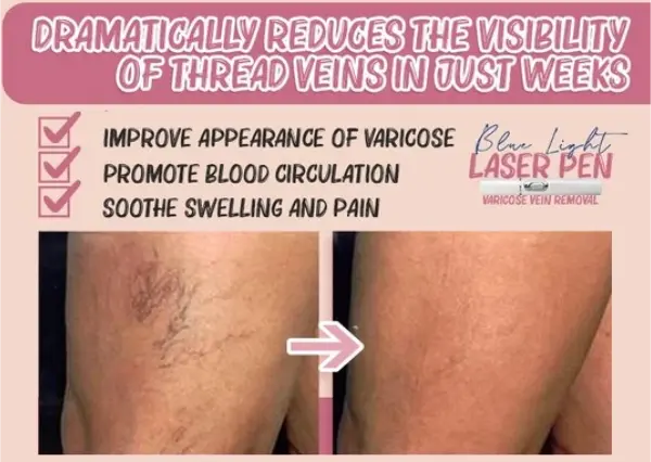 spider-veins-removal-pen