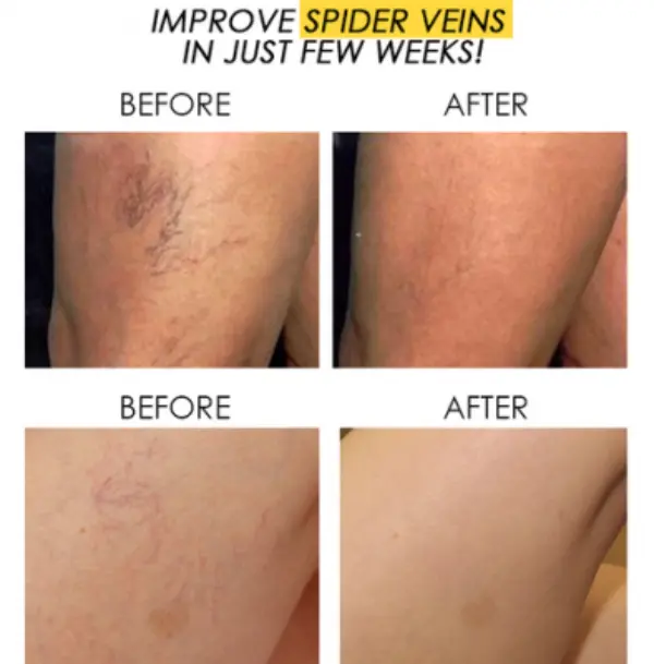 spider-veins-removal-pen