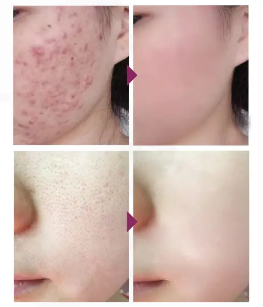 Acne Treatment Face Cream Blackhead Repair Gel Oil Control Shrink Pores Scar Whitening Moisturizer3