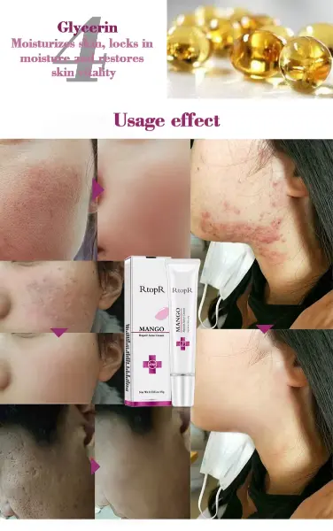 Acne Treatment Face Cream Blackhead Repair Gel Oil Control Shrink Pores Scar Whitening Moisturizer4