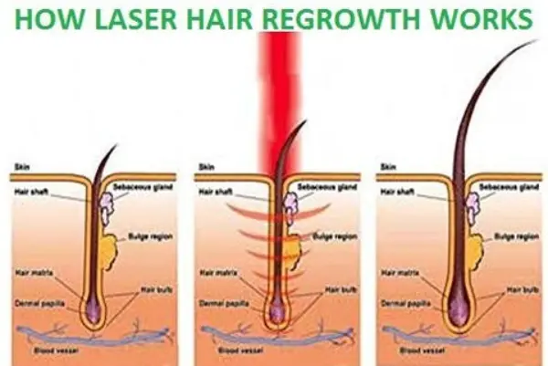 Professional Hair Regrowth Laser Comb1