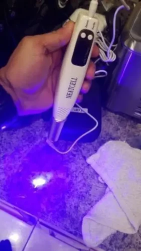 Laser Pen for Mole, Tattoo, Dark Spot, Acne Removal at Home photo review