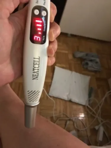 Laser Pen for Mole, Tattoo, Dark Spot, Acne Removal at Home photo review