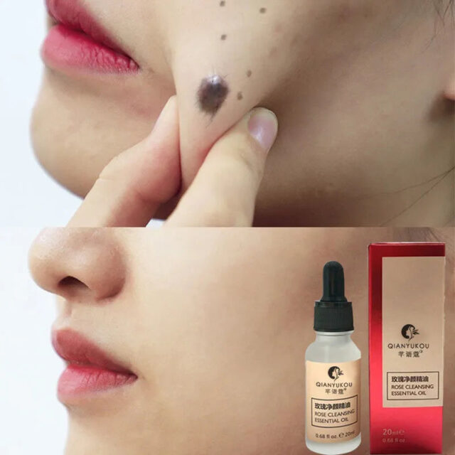 Organic Skin Tag & Dark Spot Removal Oil